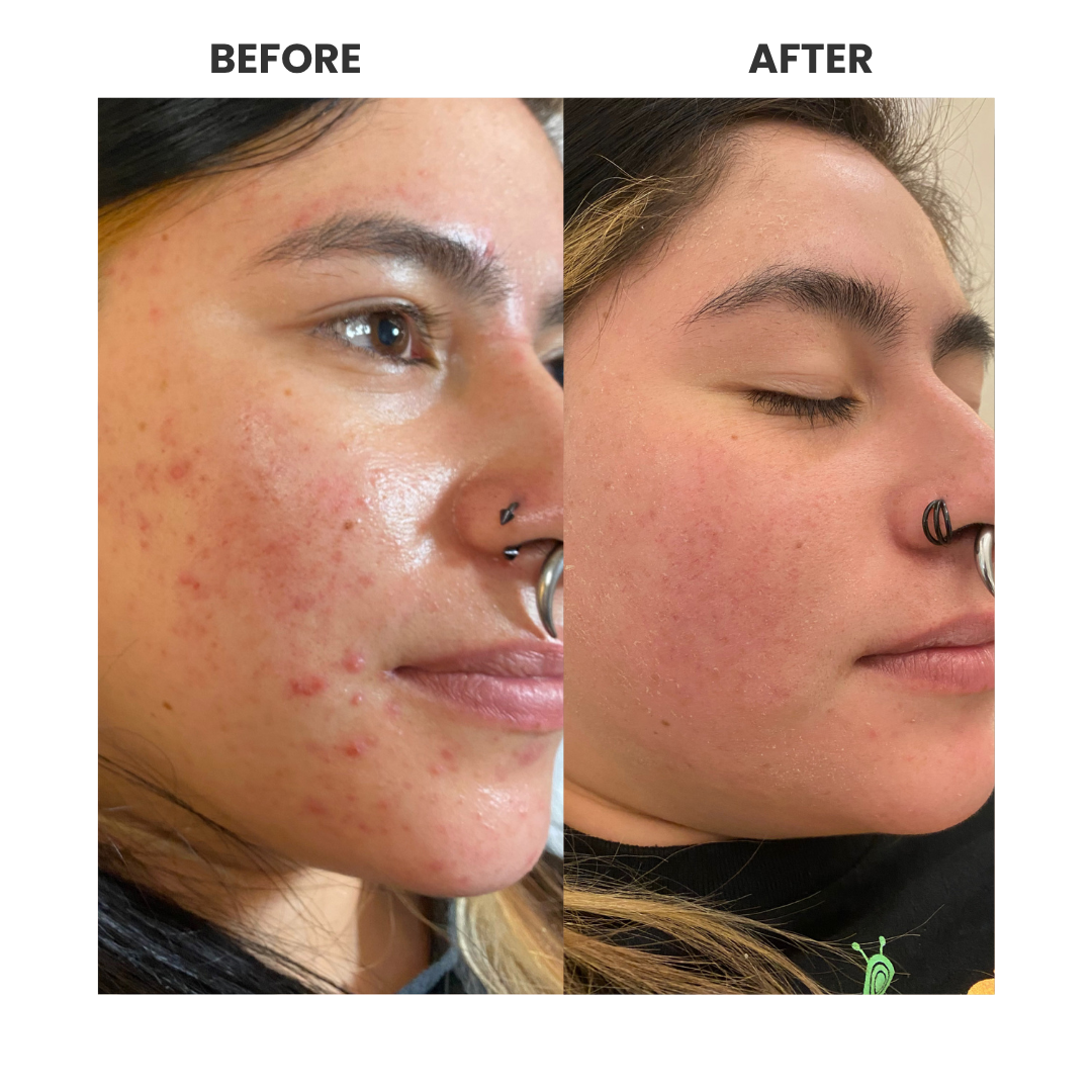 Resultados profesionales de tratamiento facial